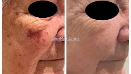 Sciton BBL Diamond Corrective Treatment