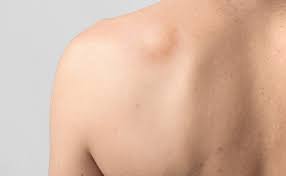 lipoma