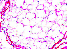 lipoma histology